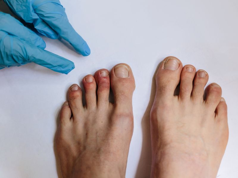 Covid-lábujj: tünetek, kezelés és amikor orvoshoz kell fordulni