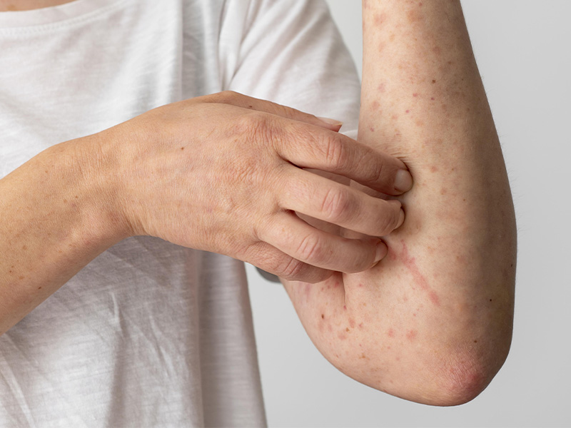 A kanyaró újra terjed Európában és Ázsiában