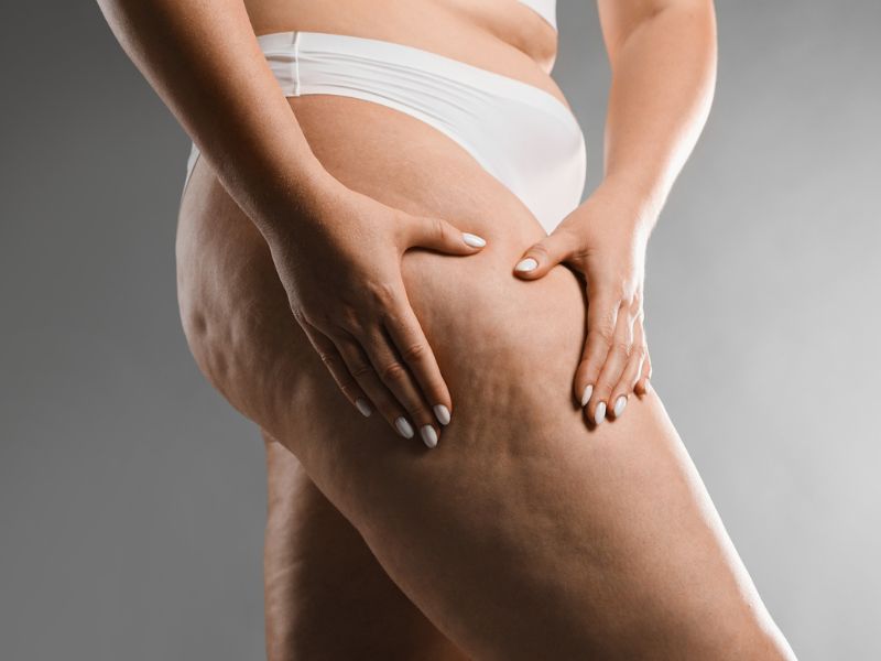 A narancsbőr nőknél egy komplex jelenség