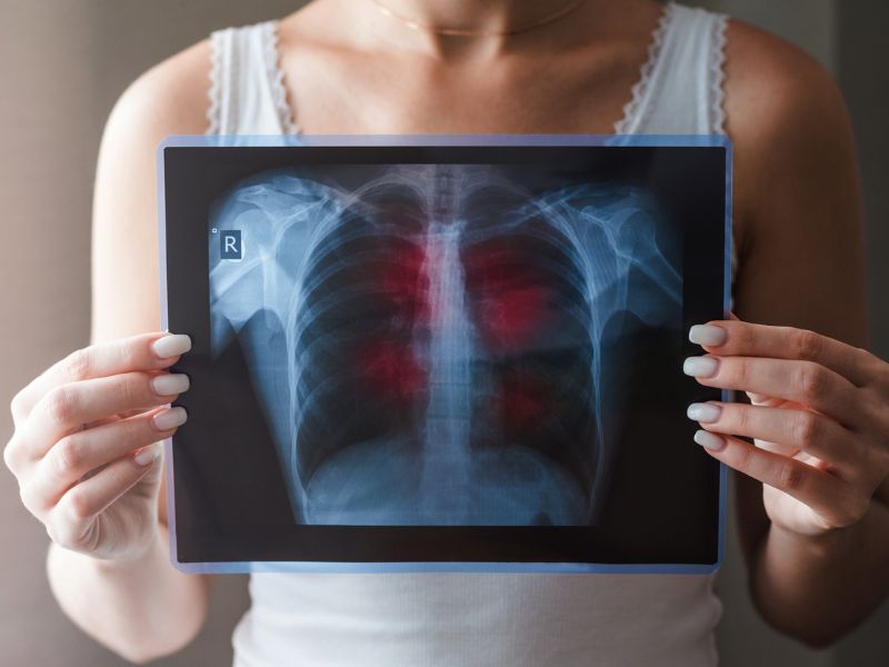 Röntgenről derült ki, hogy Hodgkin-limfóma a betegsége