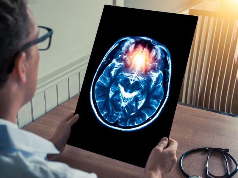 Mini stroke – a láthatatlan roham, ami súlyos károkat okoz az agyban