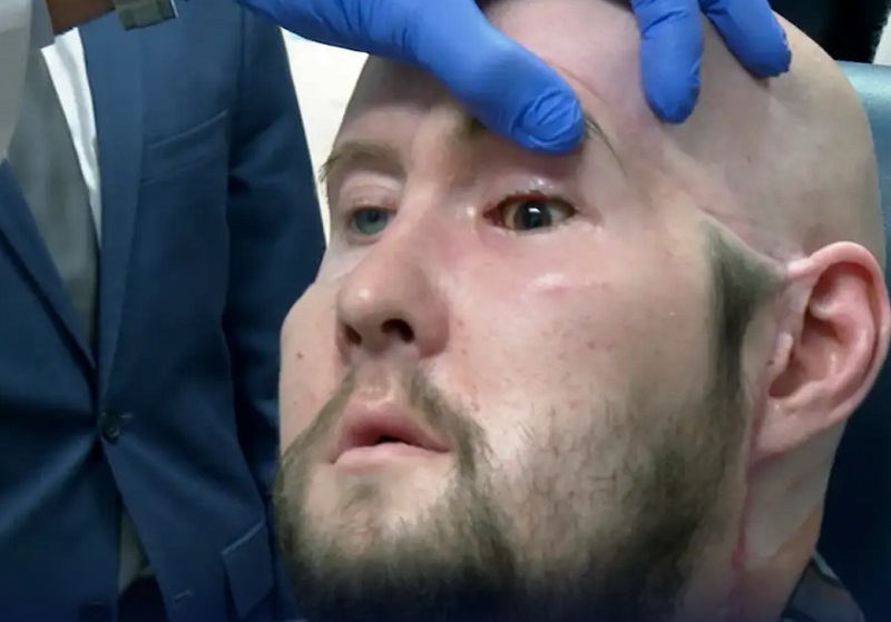 A világ első szemátültetése és arcátültetése egy férfin