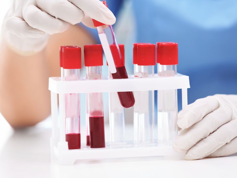 Új vérteszt mutatja meg, milyen gyors a szervek öregedése