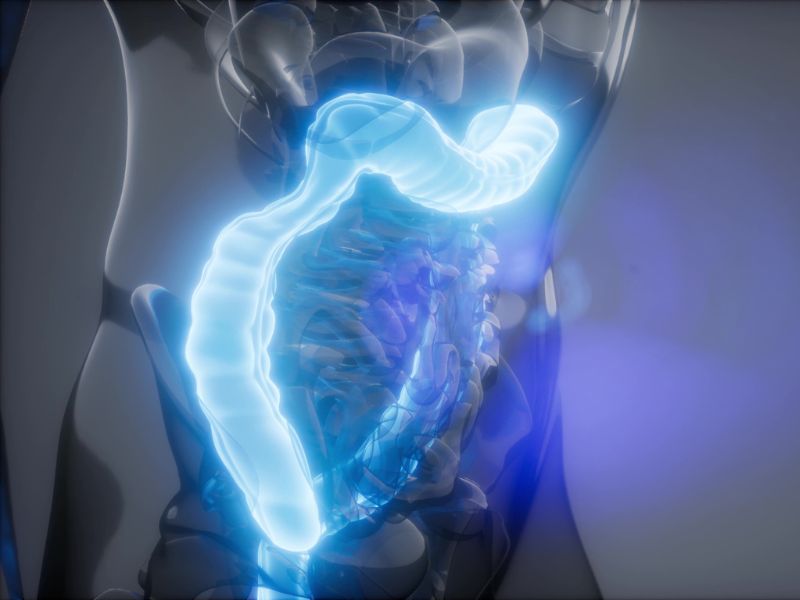 Így csökkenhet a vastagbélrák kockázata